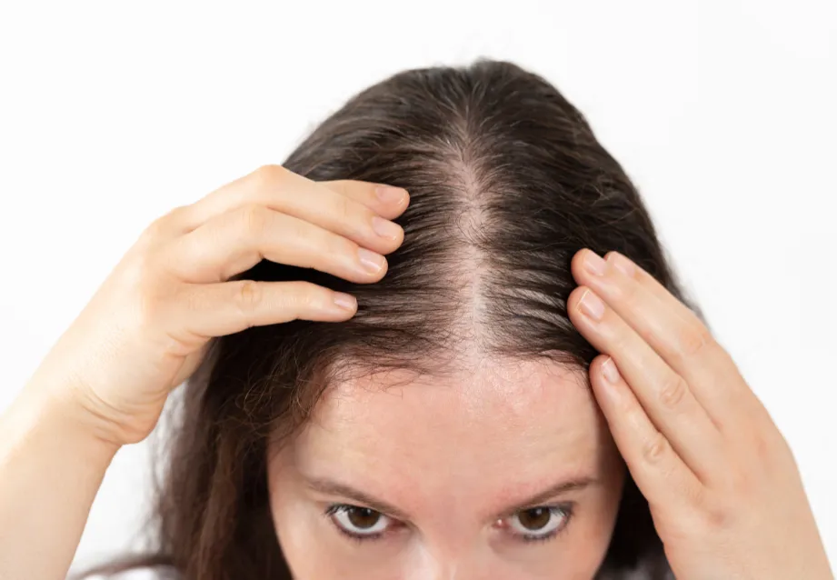 Hair is sparse and requires hair growth products.