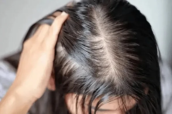 Anti Hair Loss Market